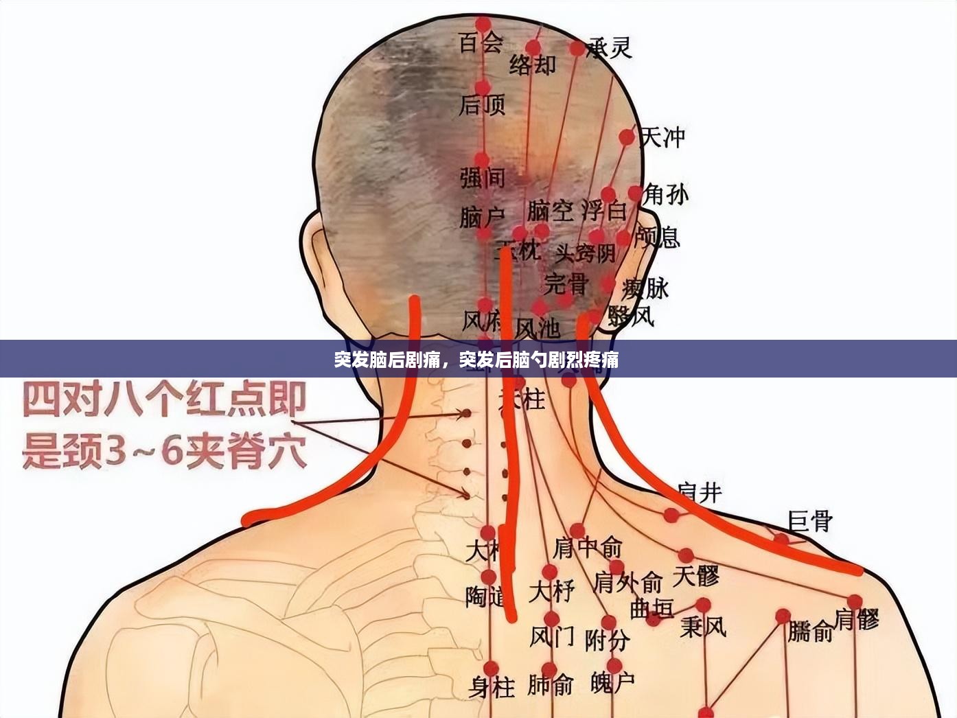 突发脑后剧痛，突发后脑勺剧烈疼痛 